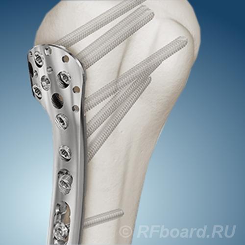 Накостный остеосинтез блокированными пластинами.  Москва