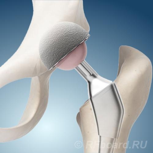 Эндопротезы.  Москва